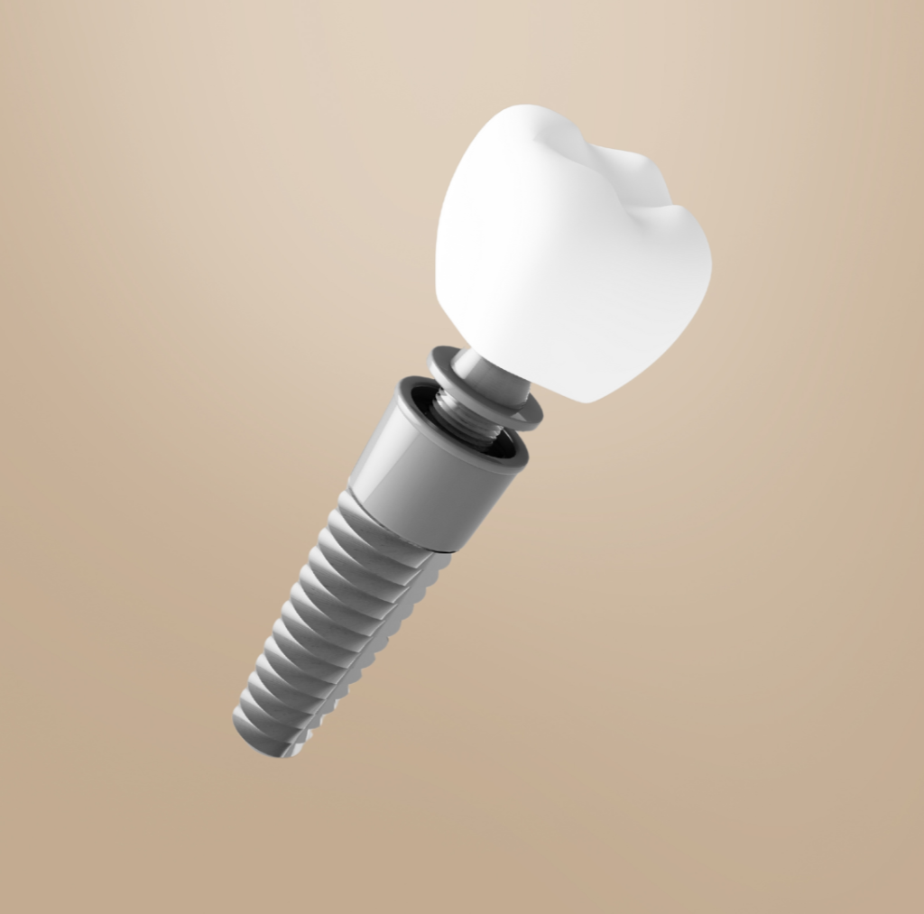 Dental Implants