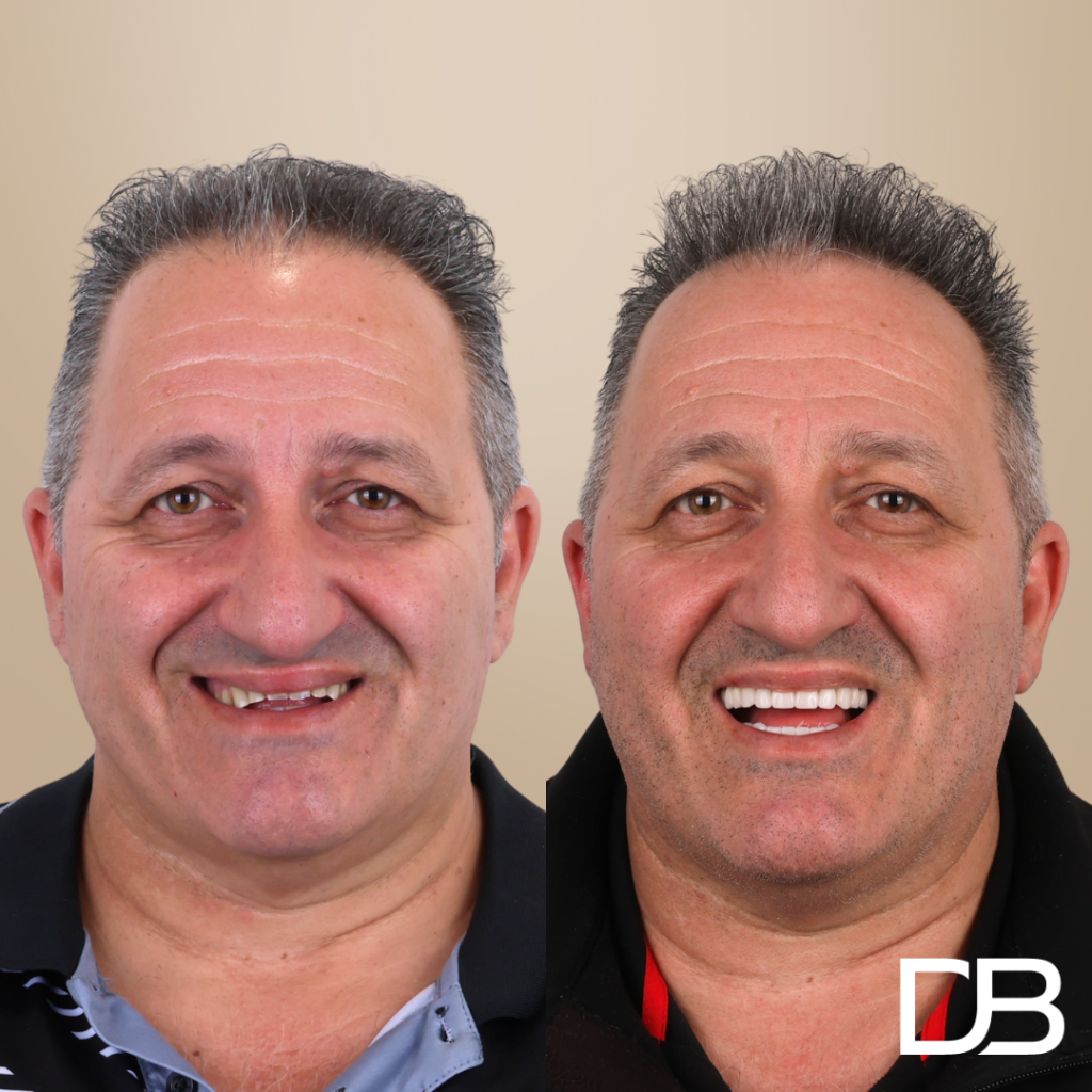 Dentures 
