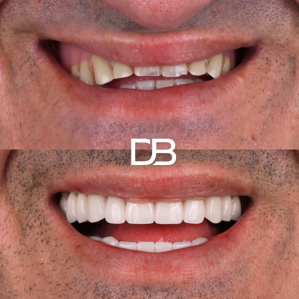 Dentures 