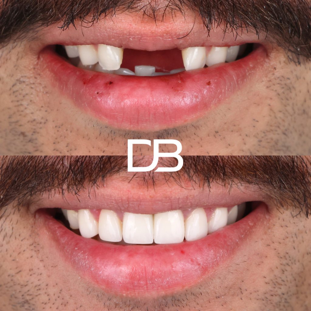 Single Implants & Porcelain Veneers 