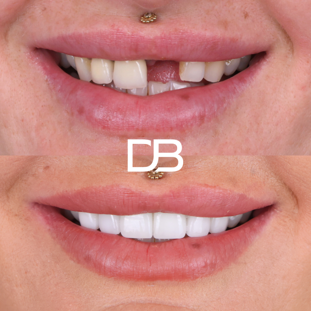 Single Implant, Bridge and Porcelain Veneers